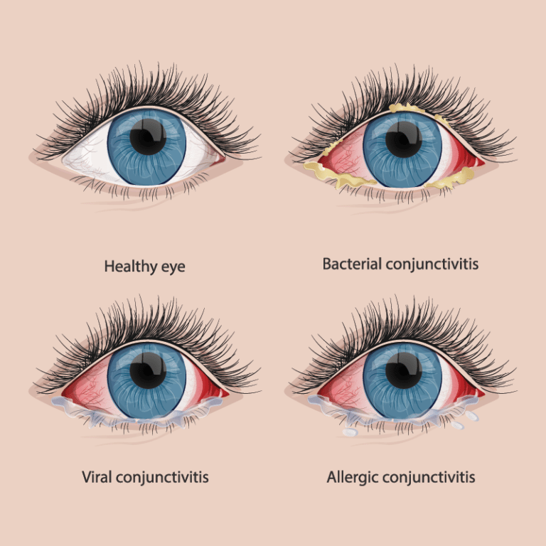 Conjunctivitis Wheaton | Cornea & External Disease St. Charles, IL