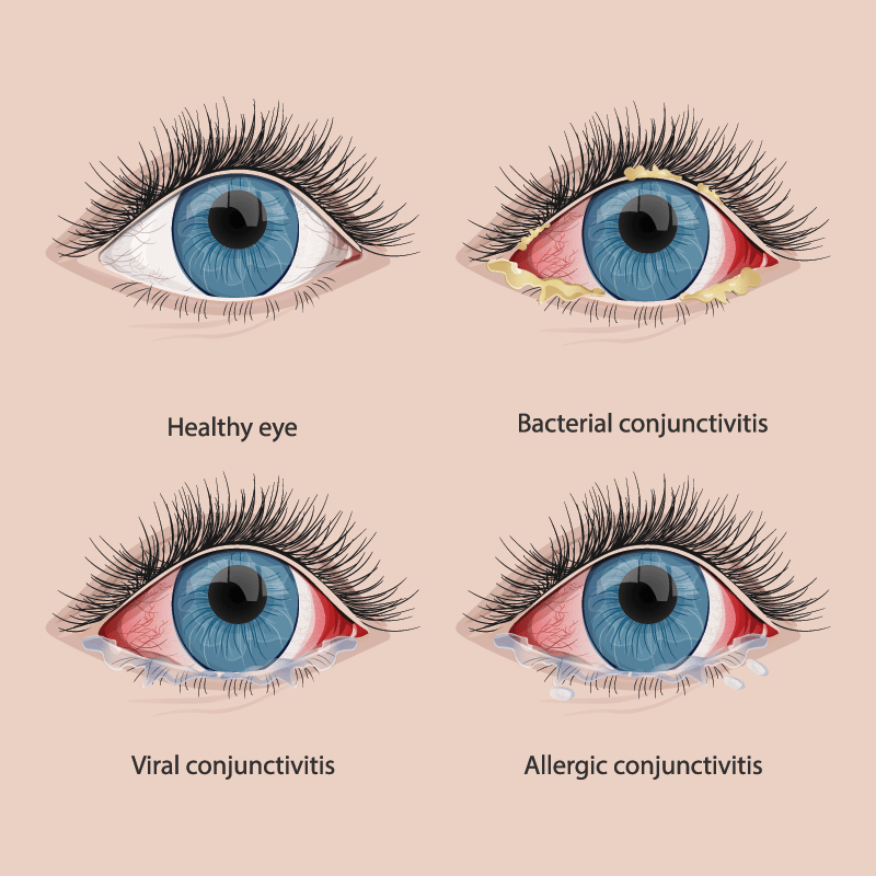 There Are Types Of Conjunctivitis All About Women