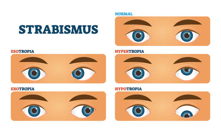 Pediatric Strabismus St Charles Pediatric Eye Exam Wheaton IL