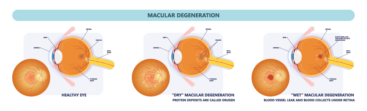 dry vs wet macular degeneration