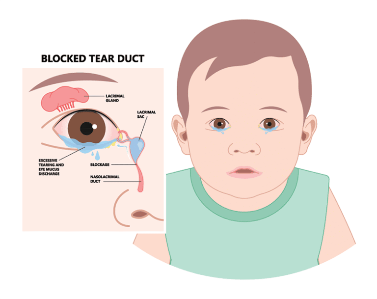 Tear Duct Obstruction Bartlett | Pediatric Eye Exam Wheaton, IL